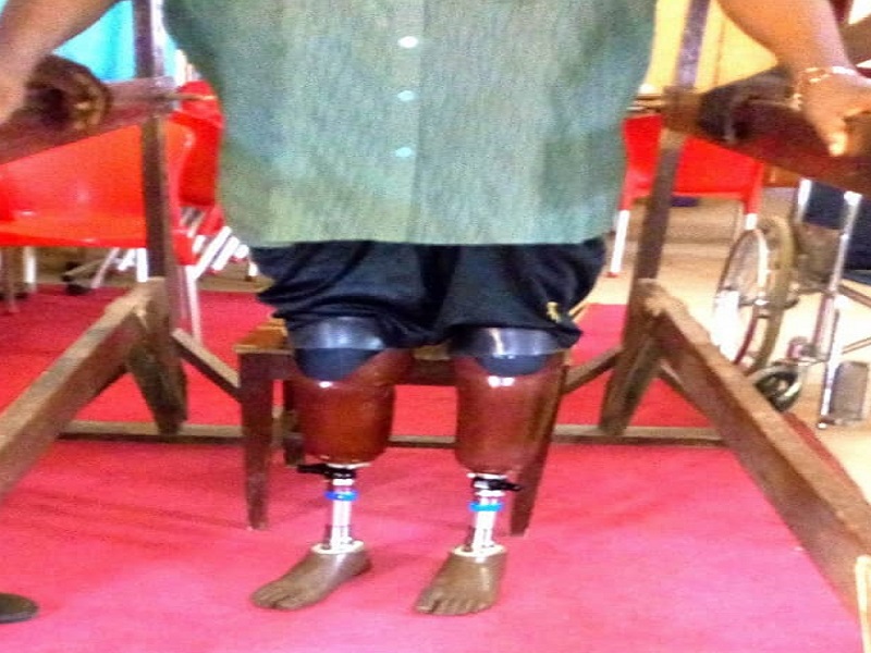 Bilateral Below-knee Prosthesis suspended with Shuttle lock mechanism